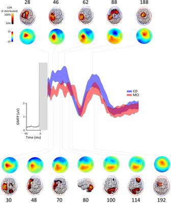 TMS-EEG Biomarkers of Amnestic Mild Cognitive Impairment Due to Alzheimer’s Disease: A Proof-of-Concept Six Years Prospective Study